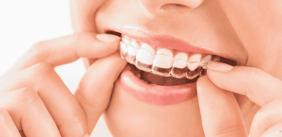 Effective Teeth Alignment for Kids in Gachibowli: A Comprehensive Guide